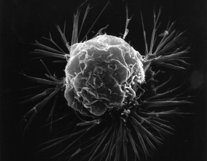 Imagem de microscópio eletrônico de células cancerígenas